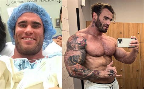 calum von moger surgery.